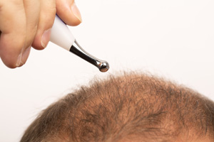 Alopecia Restoration Using FUE