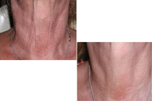 Karisma–Stimulation of Collagen Production–Anti–Aging